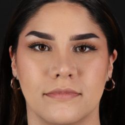 Rhinoplasty Before & After Patient #5574