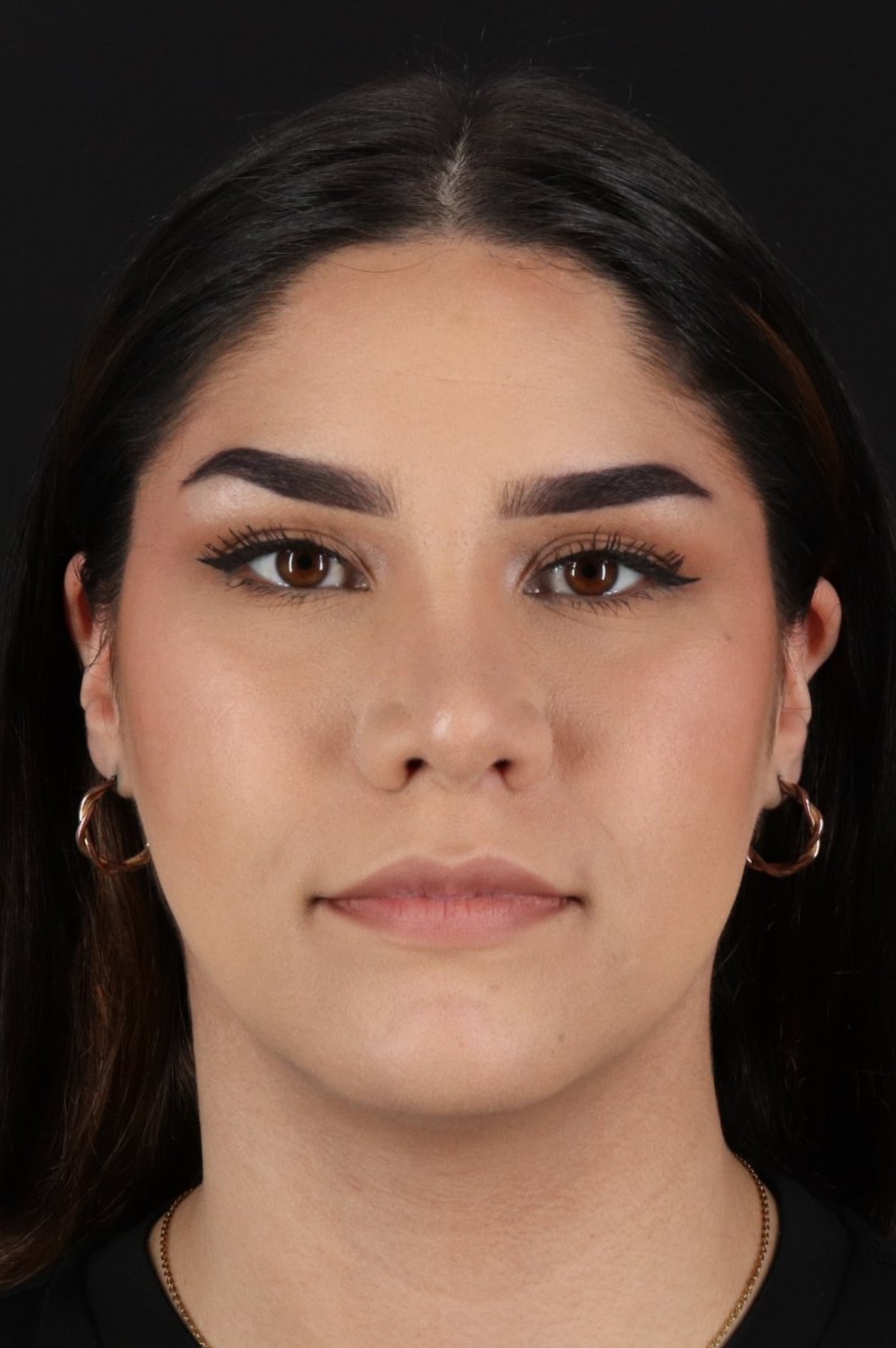 Rhinoplasty Before & After Patient #5574