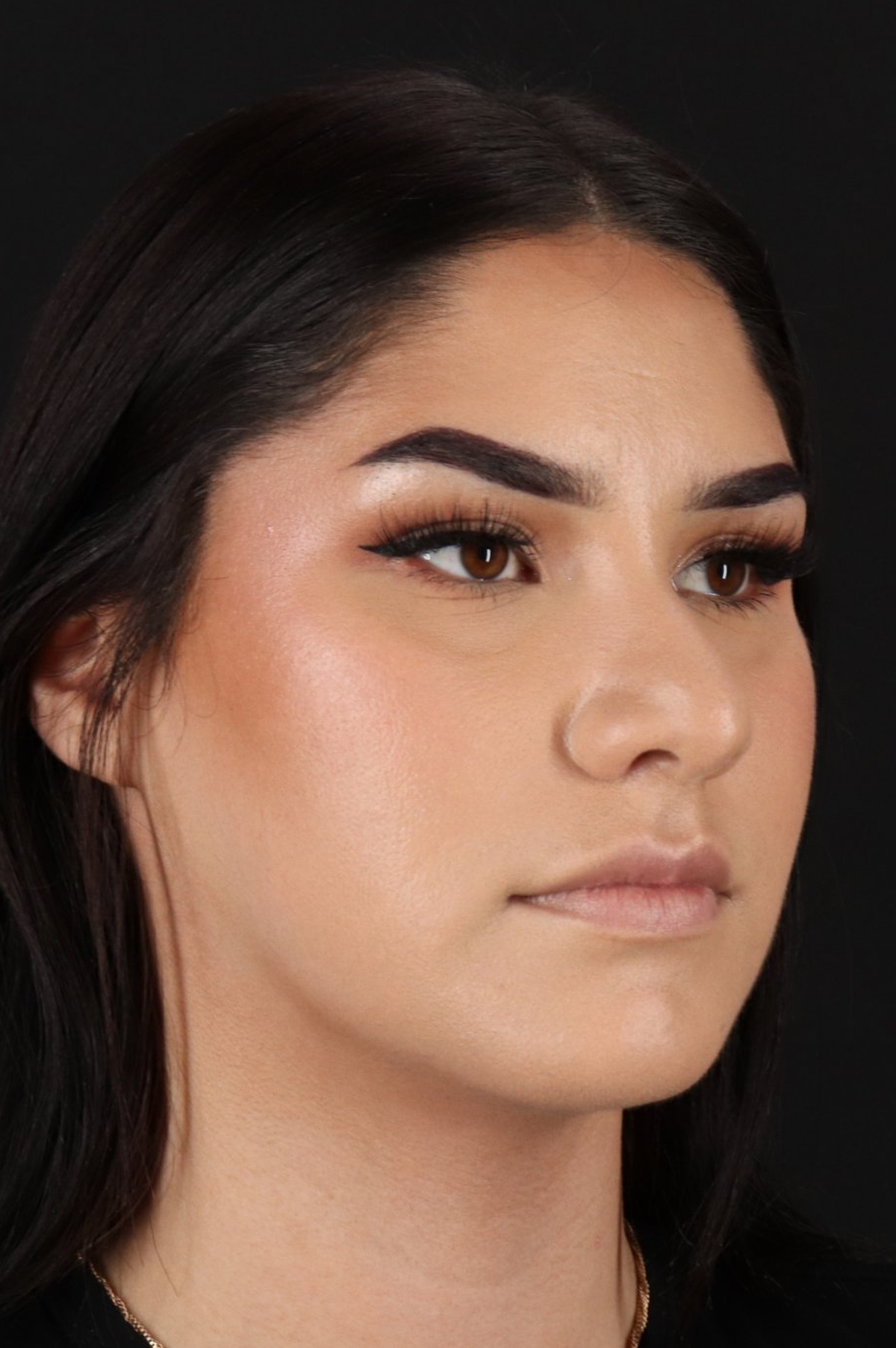 Rhinoplasty Before & After Patient #5574