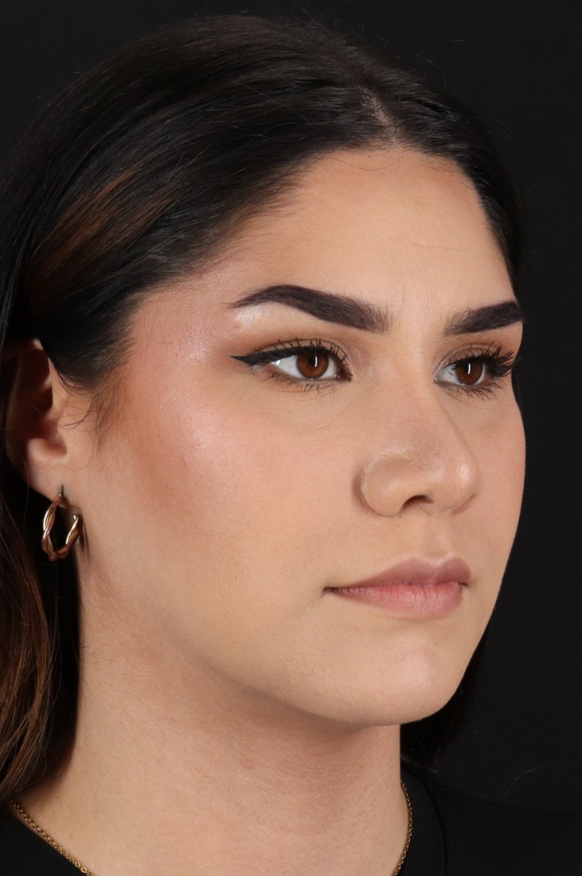 Rhinoplasty Before & After Patient #5574