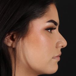 Rhinoplasty Before & After Patient #5574