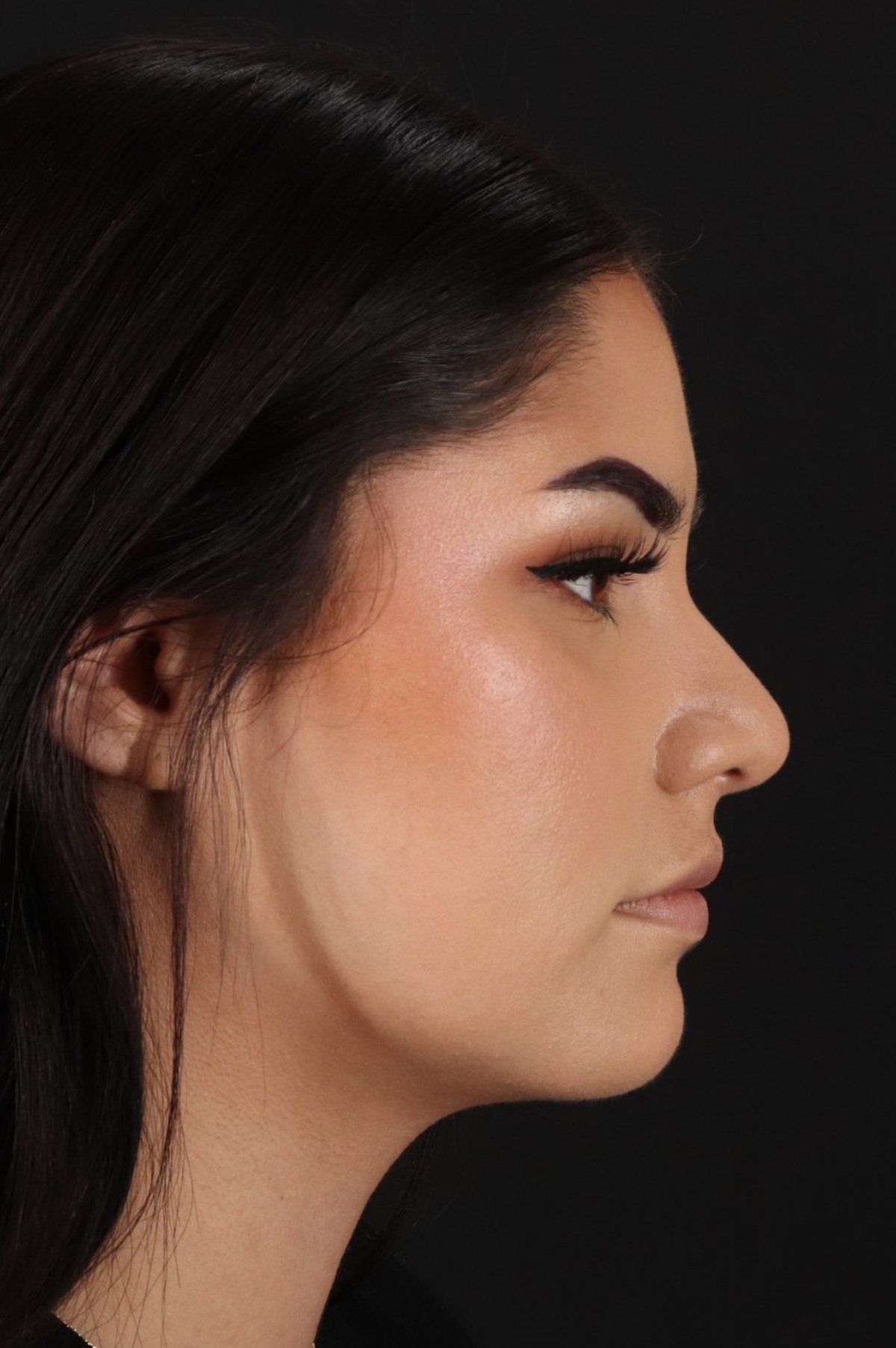 Rhinoplasty Before & After Patient #5574