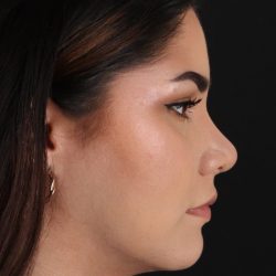 Rhinoplasty Before & After Patient #5574
