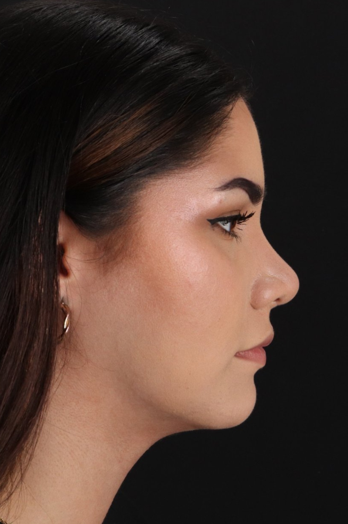 Rhinoplasty Before & After Patient #5574