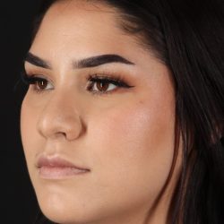 Rhinoplasty Before & After Patient #5574
