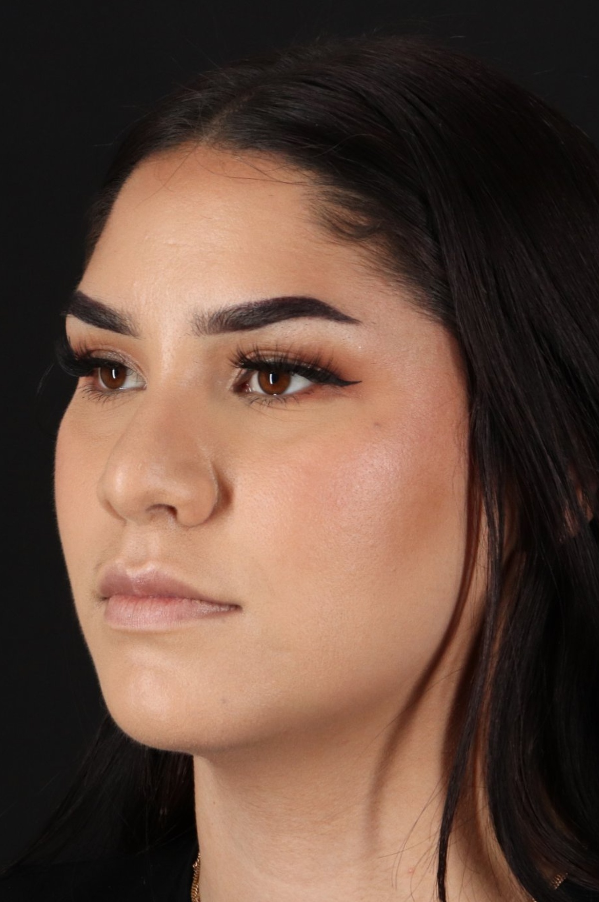 Rhinoplasty Before & After Patient #5574