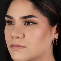 Rhinoplasty Before & After Patient #5574
