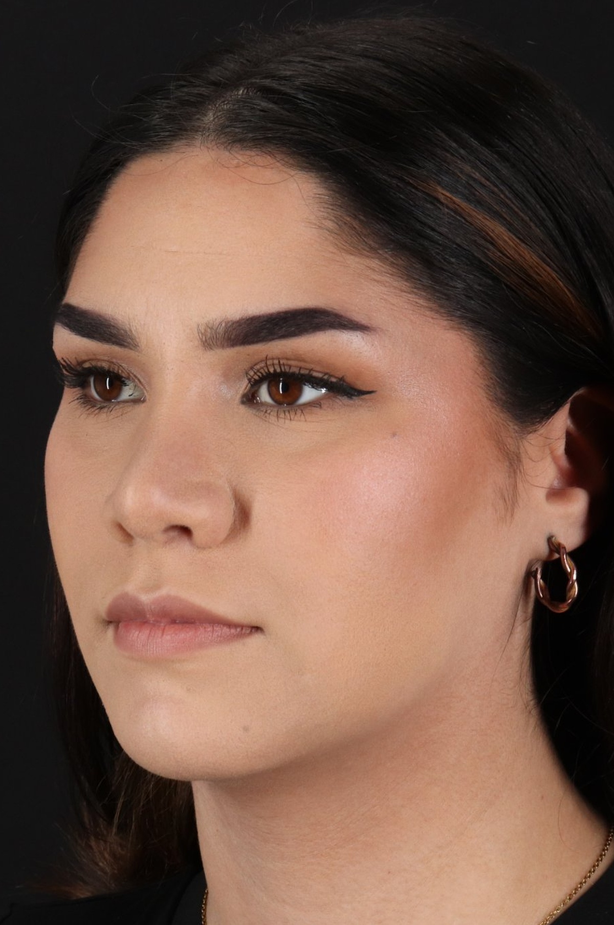Rhinoplasty Before & After Patient #5574