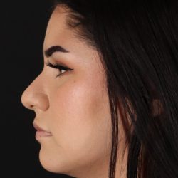 Rhinoplasty Before & After Patient #5574