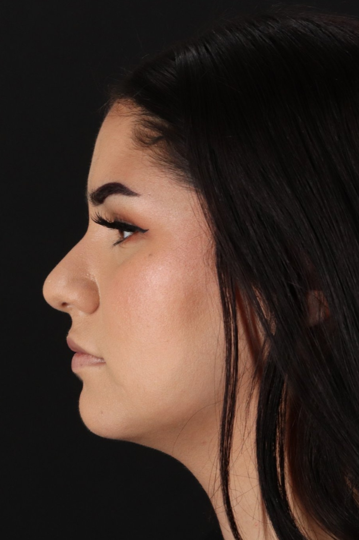 Rhinoplasty Before & After Patient #5574