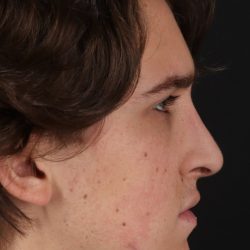 Rhinoplasty Before & After Patient #5515
