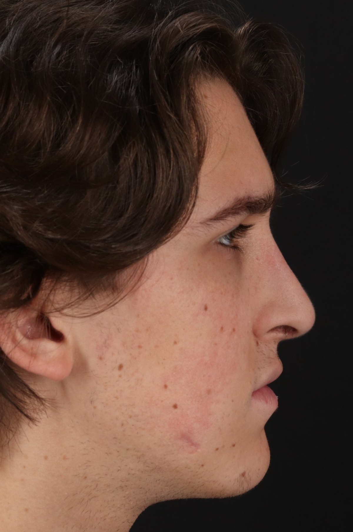 Rhinoplasty Before & After Patient #5515