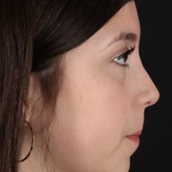 Rhinoplasty Before & After Patient #5575
