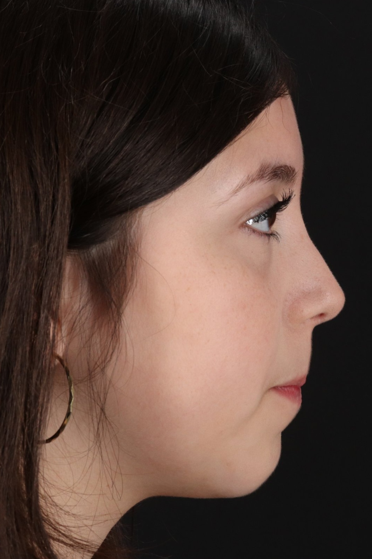 Rhinoplasty Before & After Patient #5575
