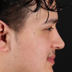 Rhinoplasty Before & After Patient #5516