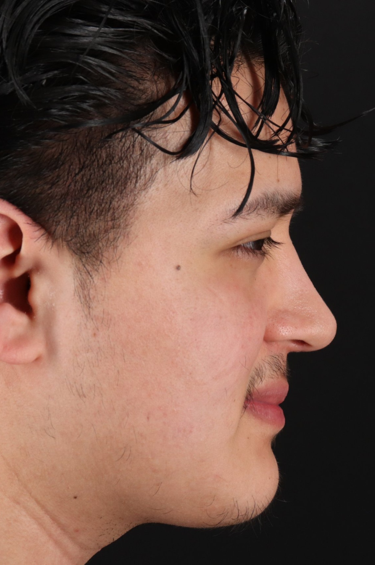 Rhinoplasty Before & After Patient #5516