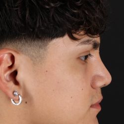 Rhinoplasty Before & After Patient #5517