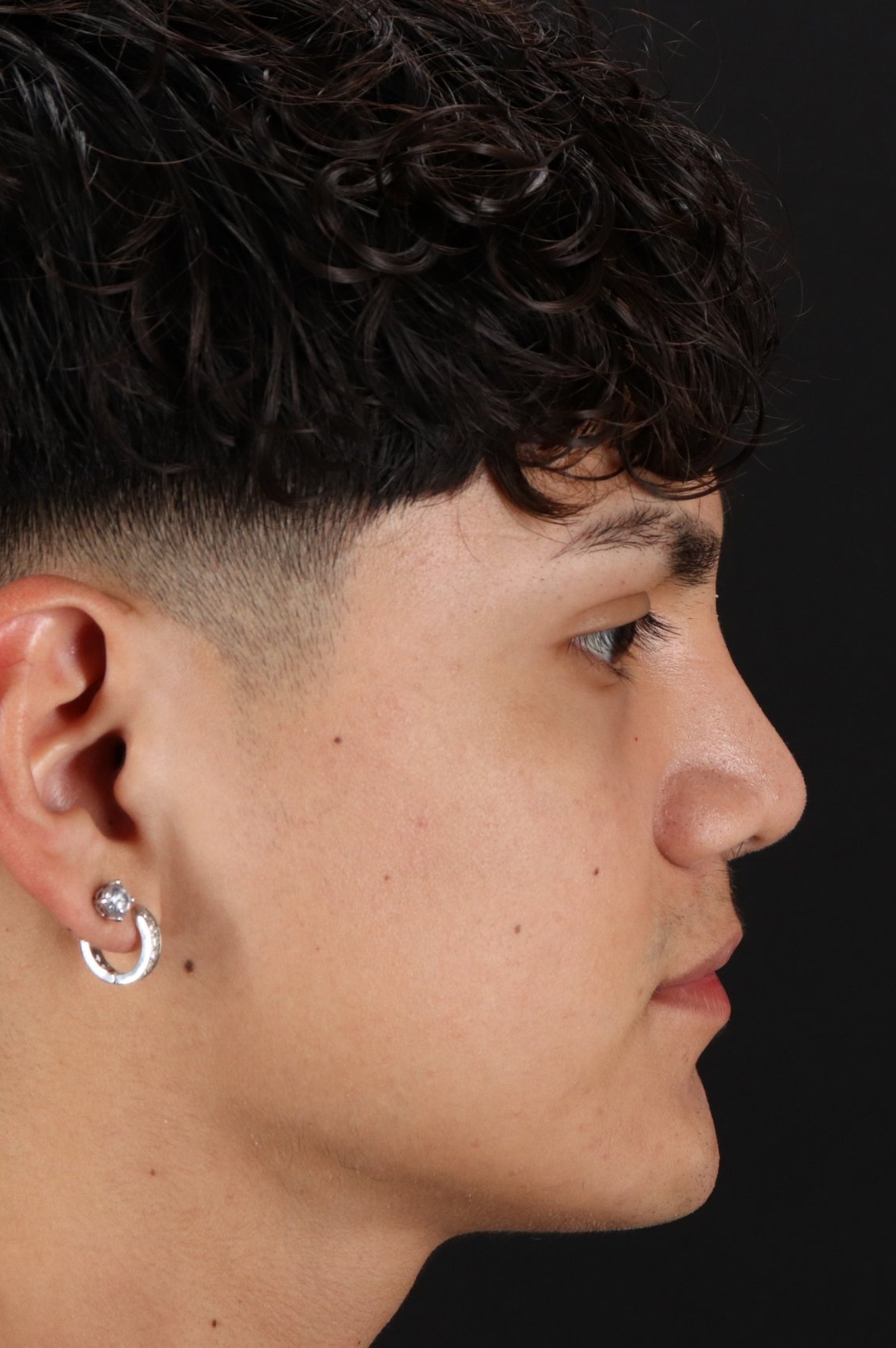 Rhinoplasty Before & After Patient #5517