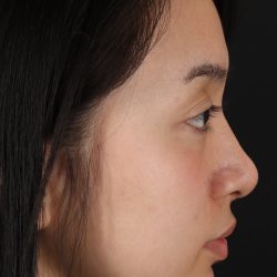 Rhinoplasty Before & After Patient #5573