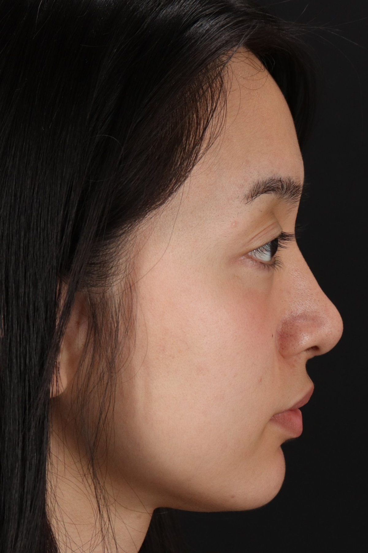 Rhinoplasty Before & After Patient #5573