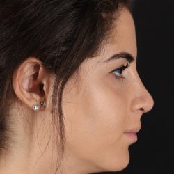 Rhinoplasty Before & After Patient #5572