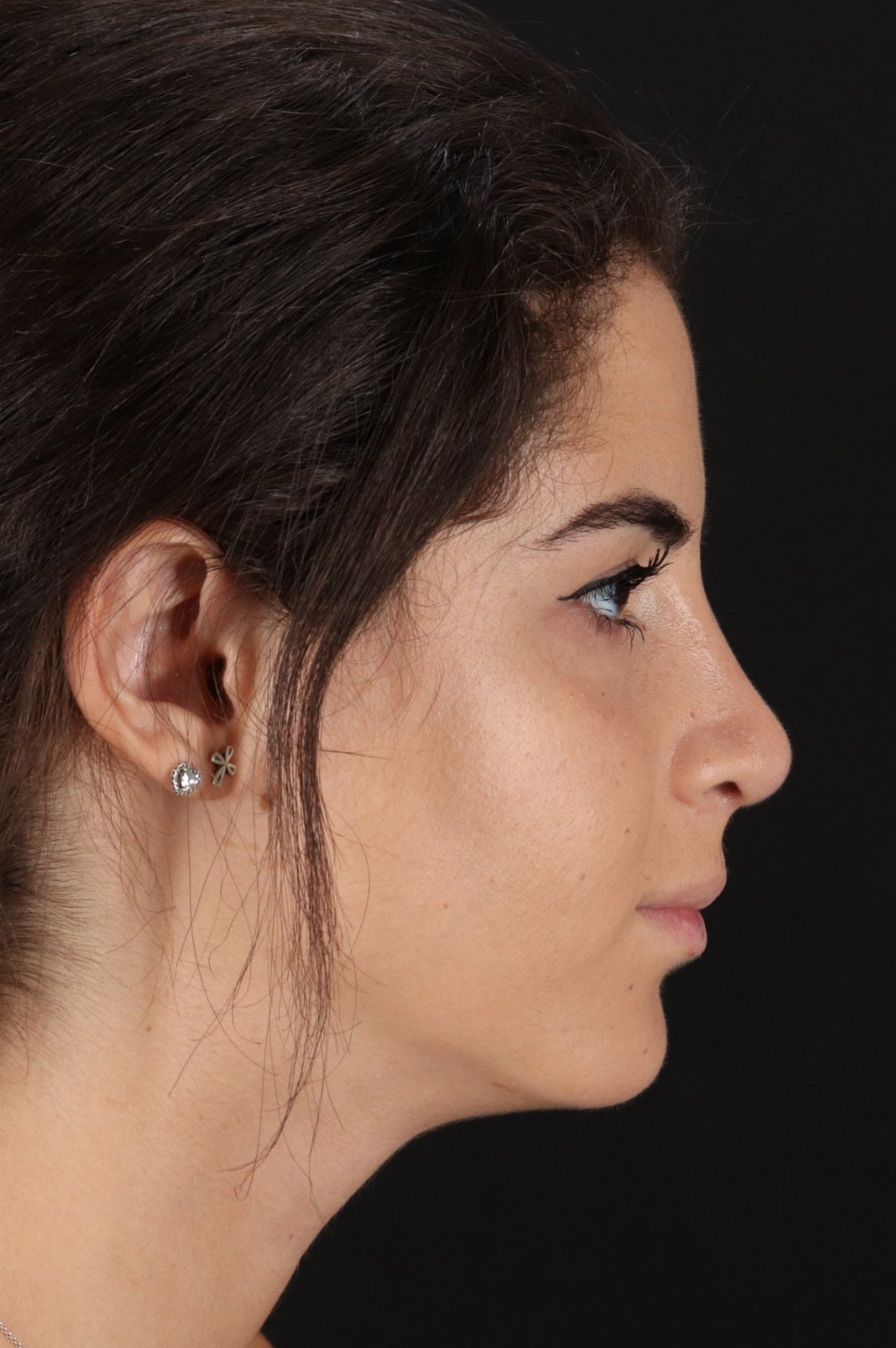 Rhinoplasty Before & After Patient #5572