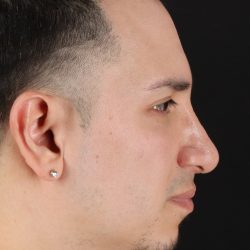Rhinoplasty Before & After Patient #5518