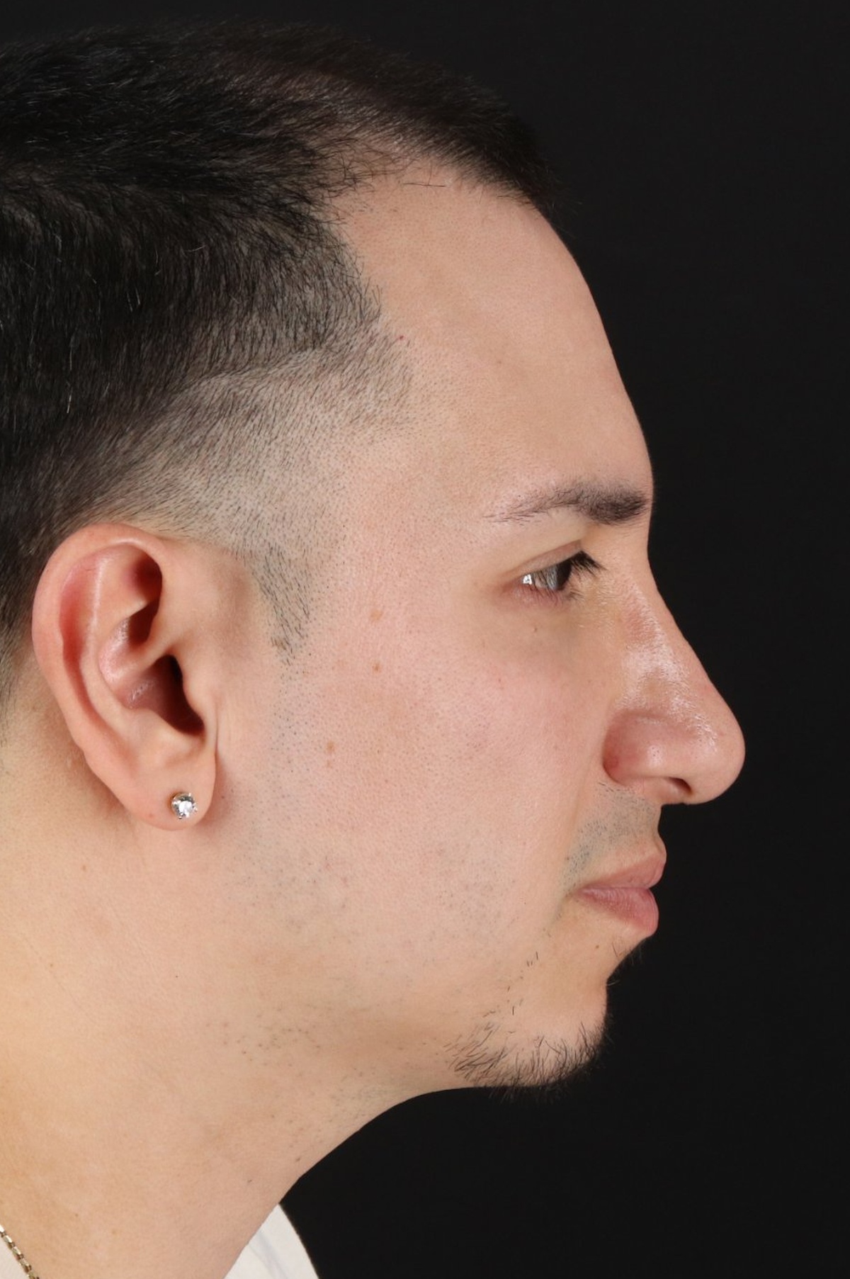Rhinoplasty Before & After Patient #5518