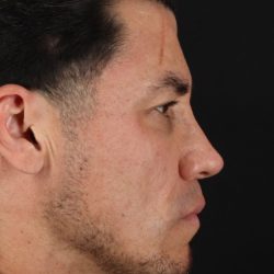 Rhinoplasty Before & After Patient #5519