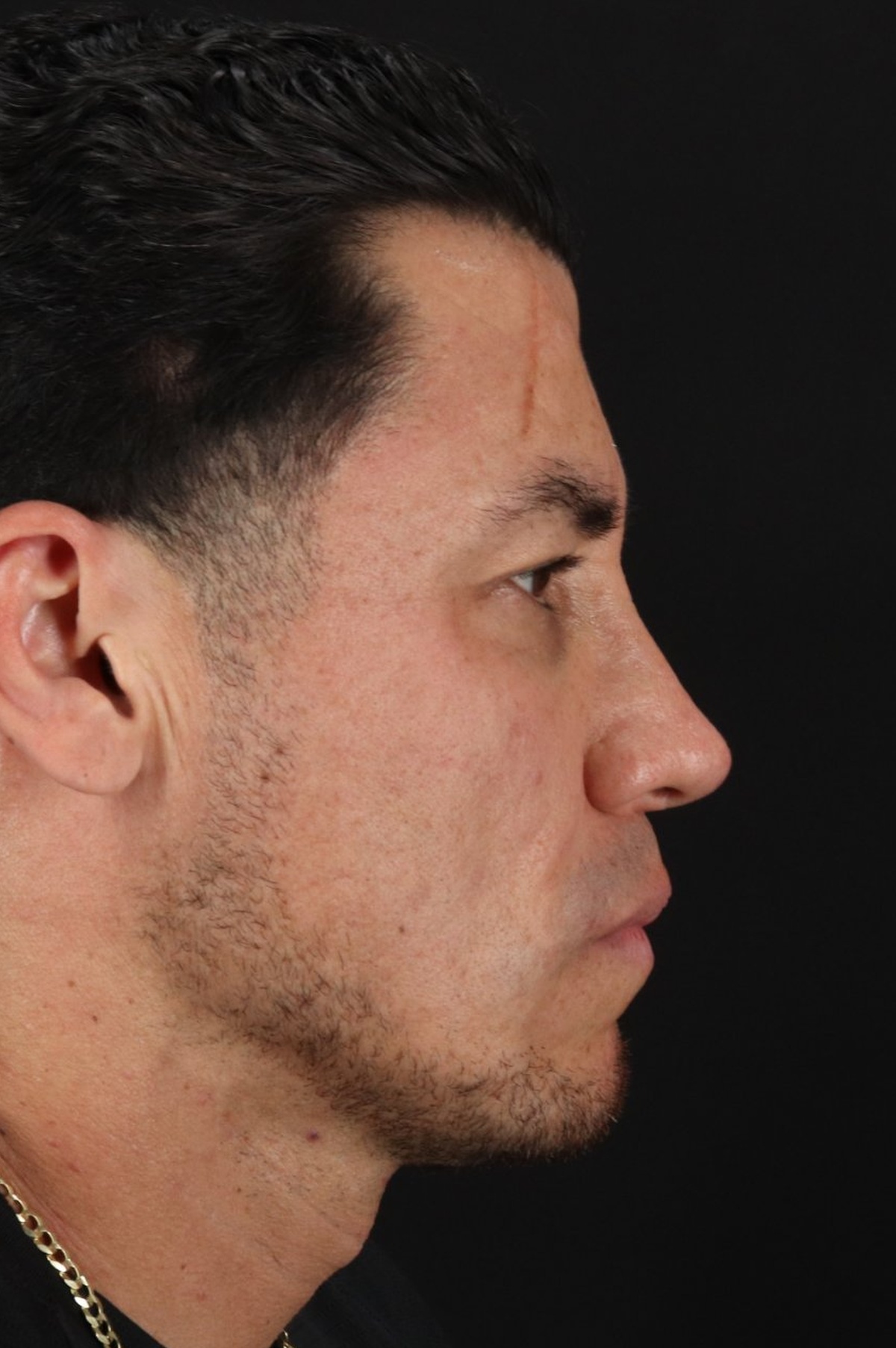 Rhinoplasty Before & After Patient #5519