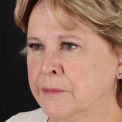 Facelift Before & After Patient #5392