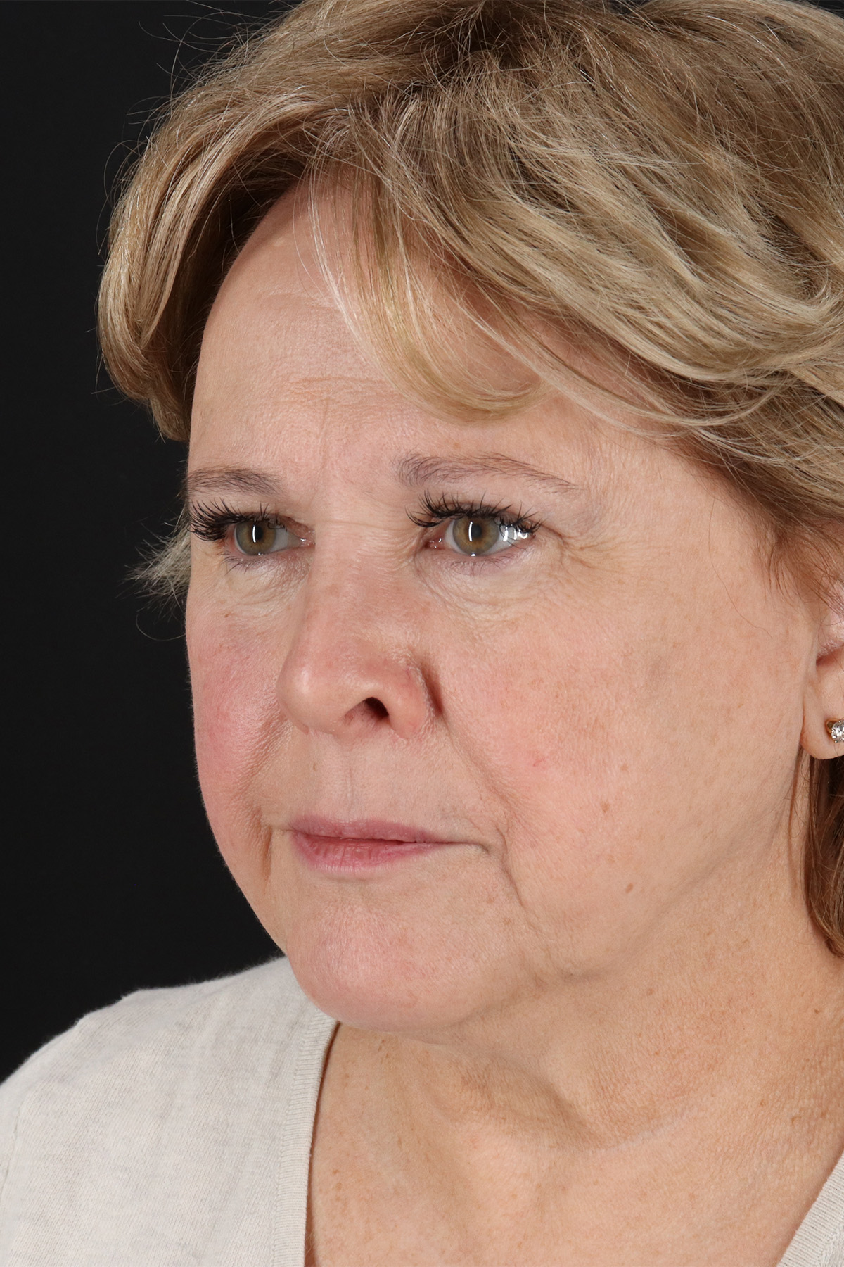 Facelift Before & After Patient #5392