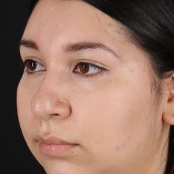 Neck Lift Before & After Patient #5395