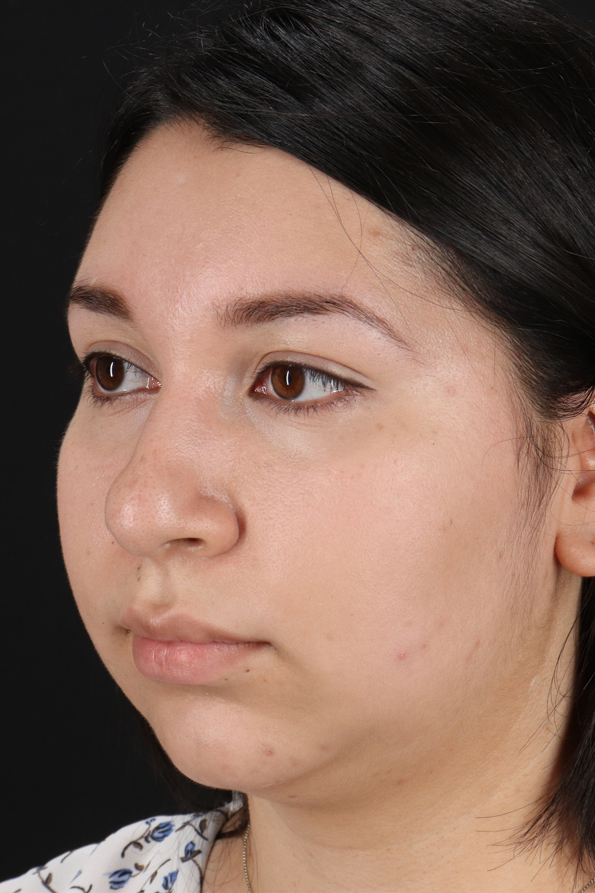 Neck Lift Before & After Patient #5395