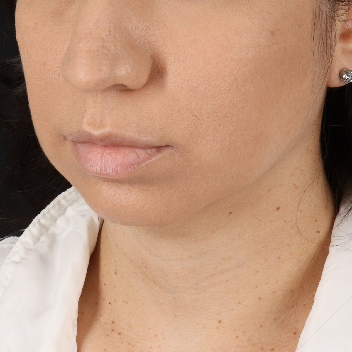 Neck Lift Before & After Patient #5396