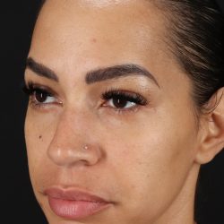 Chin Implant Before & After Patient #5390