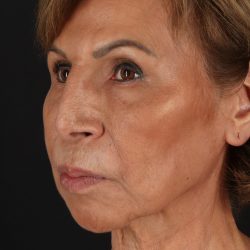 Facelift Before & After Patient #5394