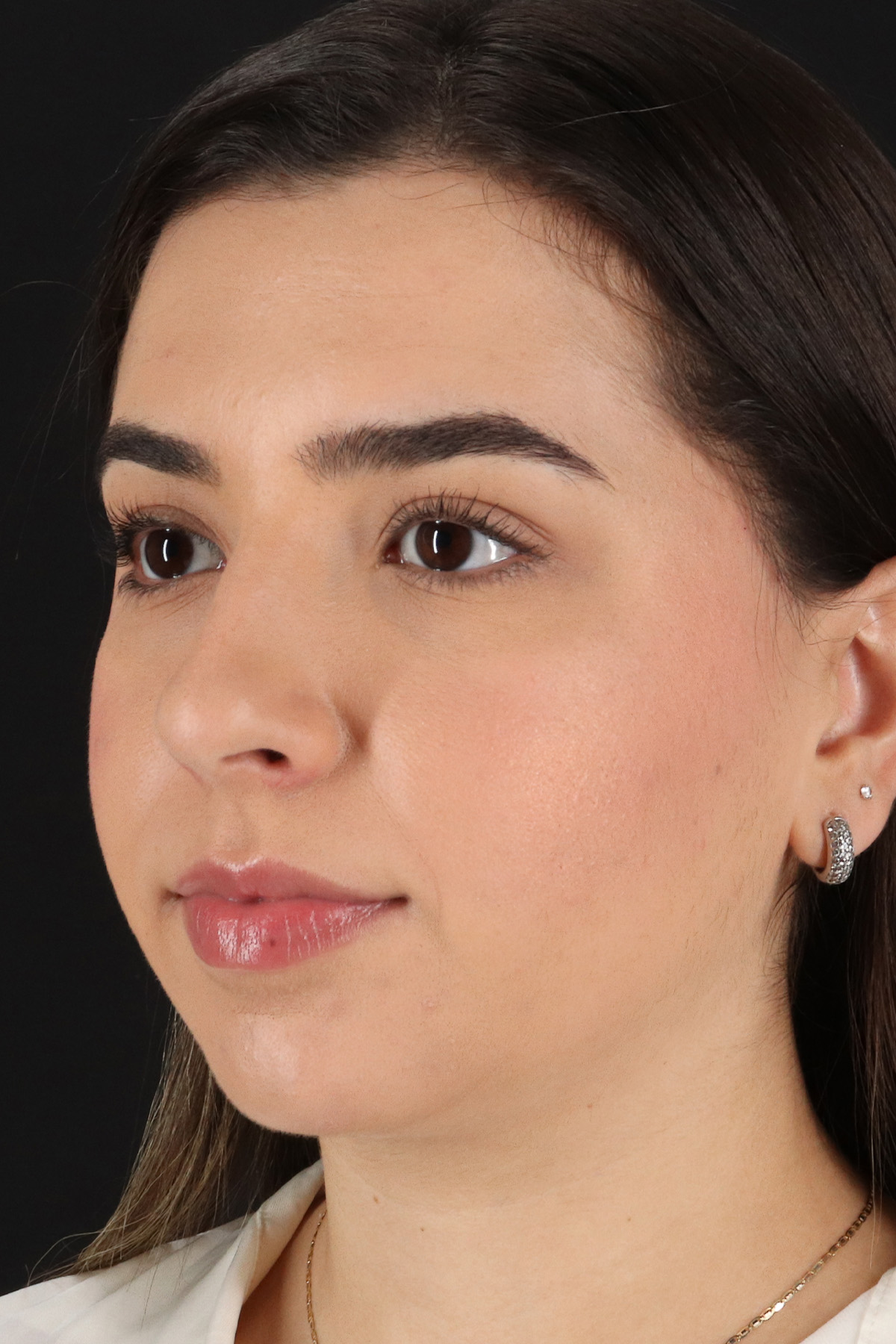 Chin Implant Before & After Patient #5391