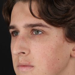 Rhinoplasty Before & After Patient #5515