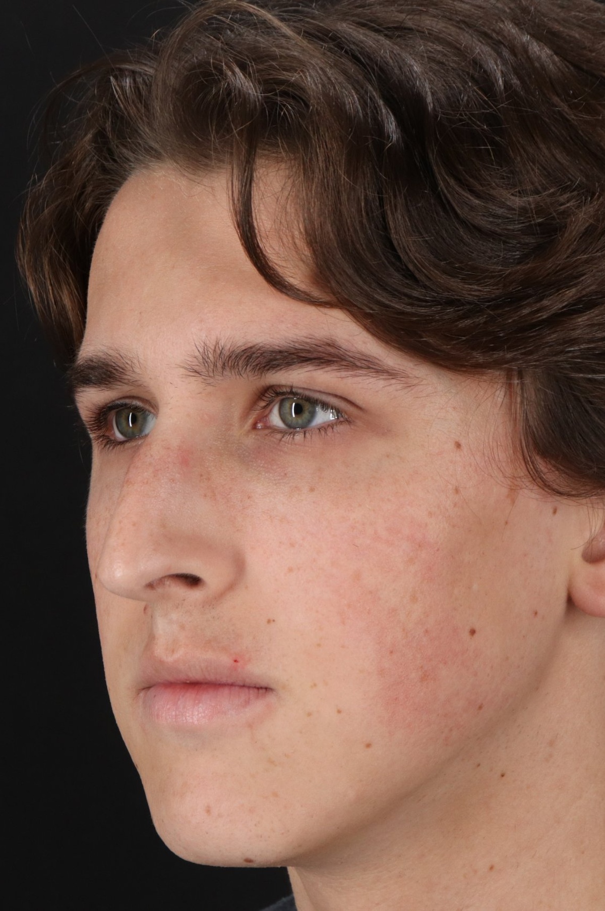 Rhinoplasty Before & After Patient #5515