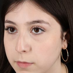 Rhinoplasty Before & After Patient #5575