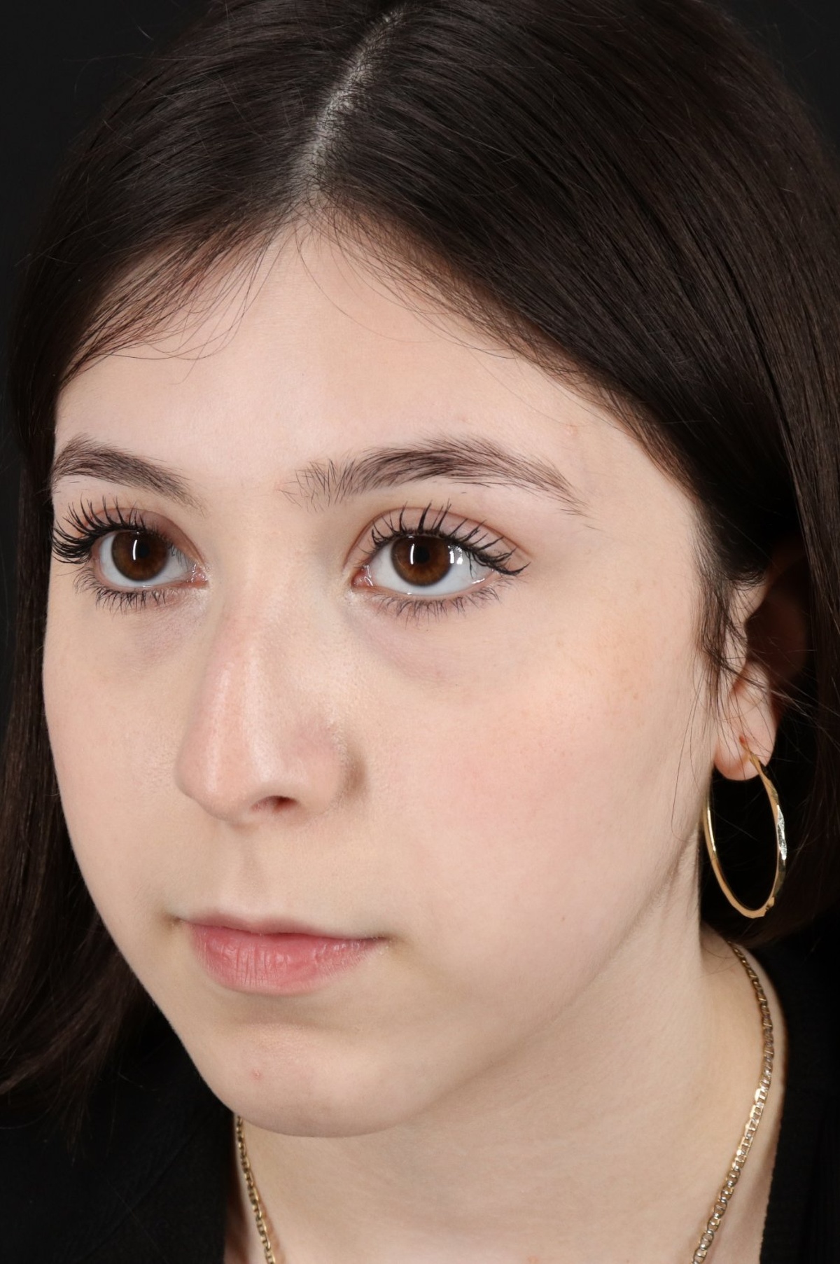 Rhinoplasty Before & After Patient #5575