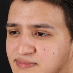 Rhinoplasty Before & After Patient #5516