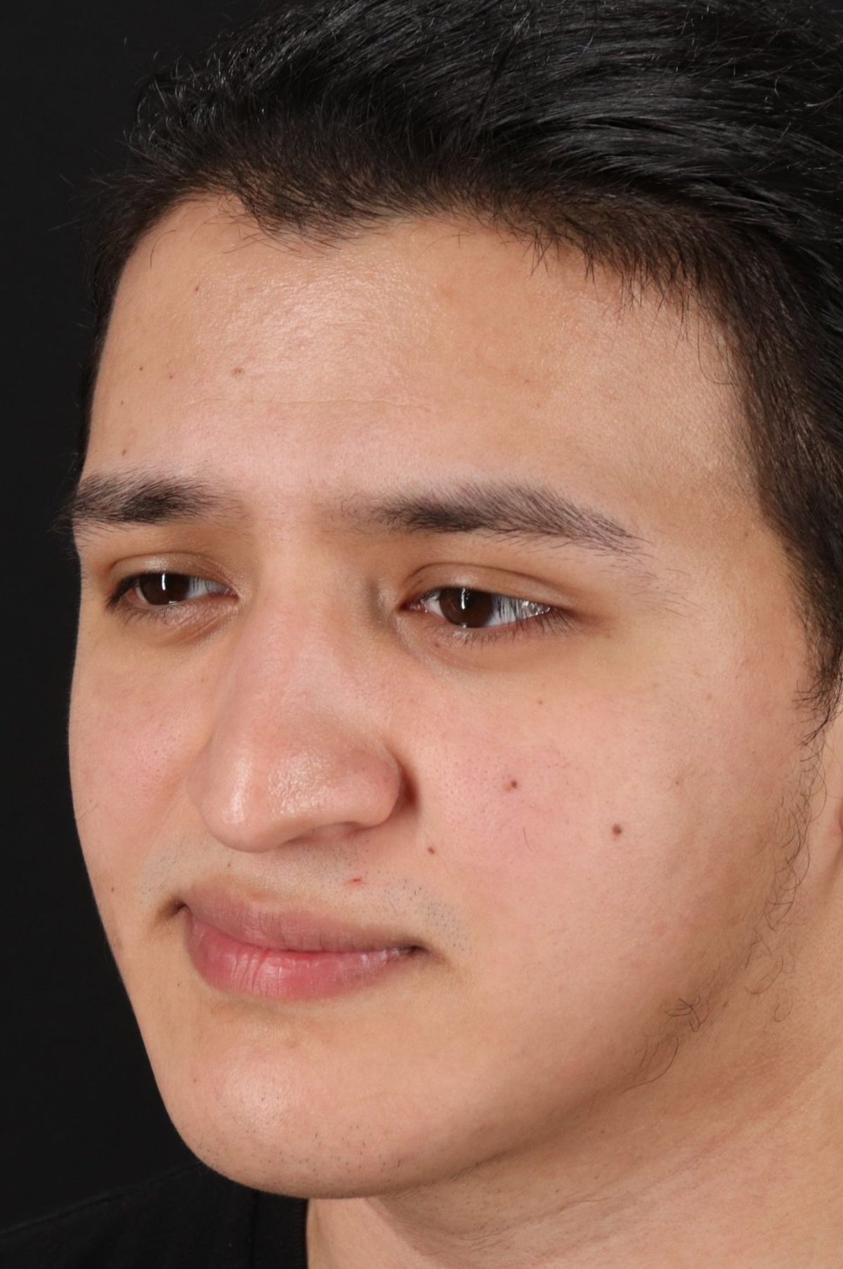 Rhinoplasty Before & After Patient #5516