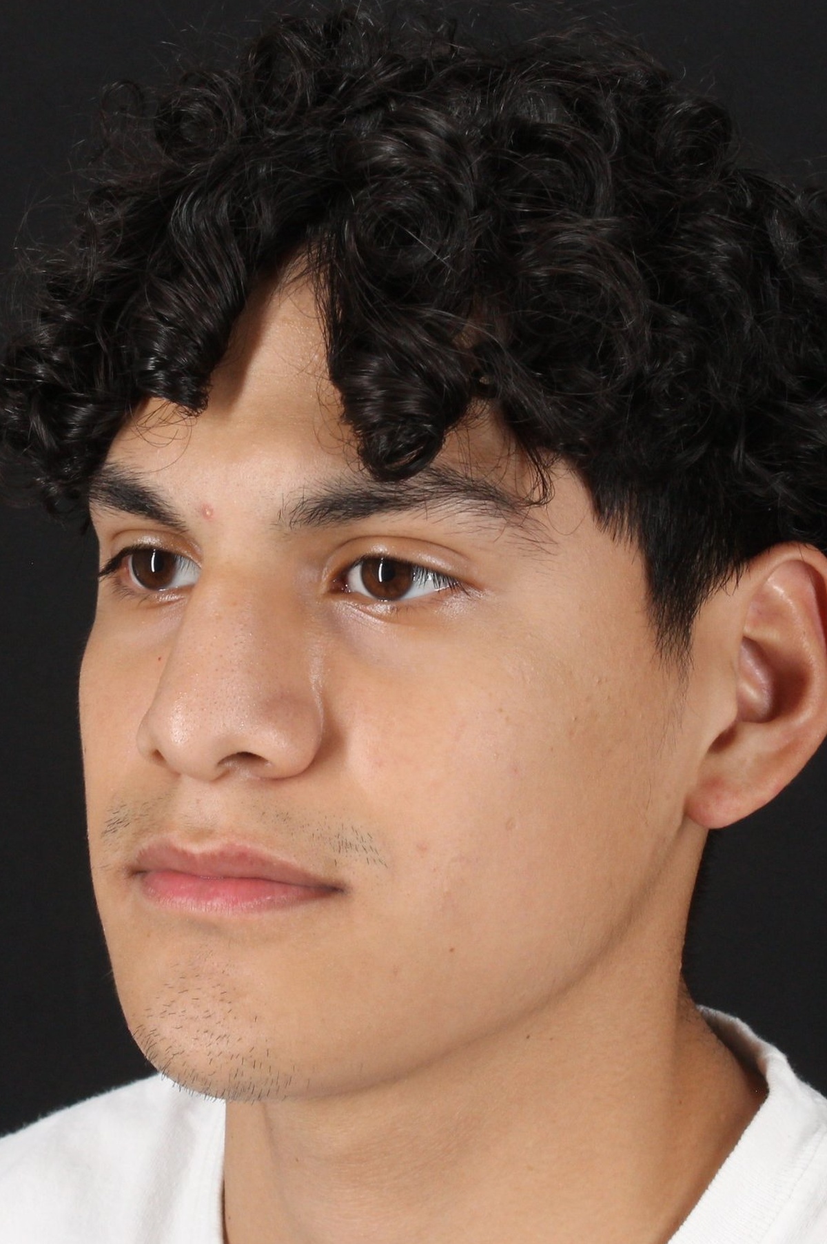 Rhinoplasty Before & After Patient #5517