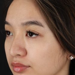 Rhinoplasty Before & After Patient #5573