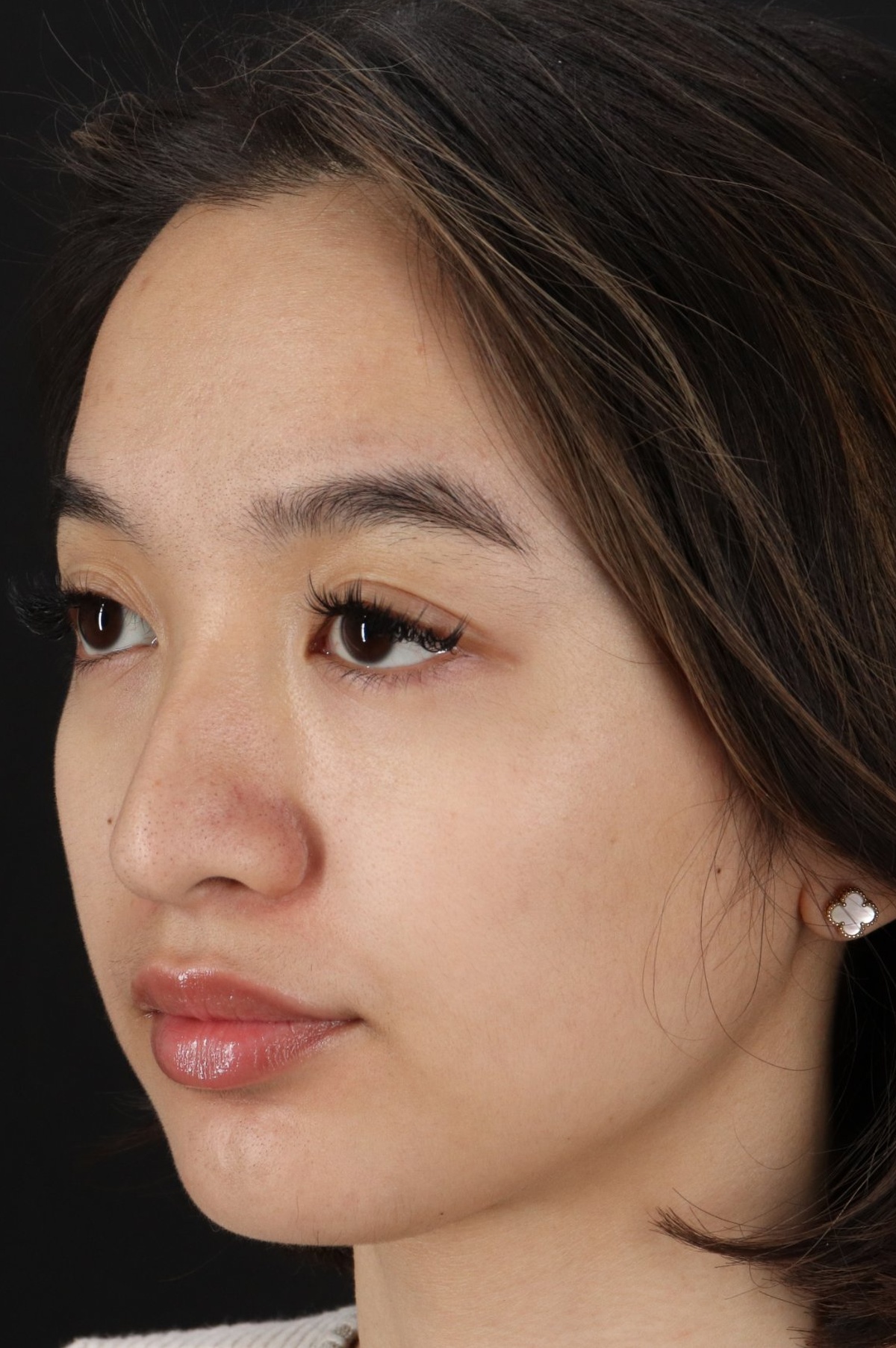 Rhinoplasty Before & After Patient #5573