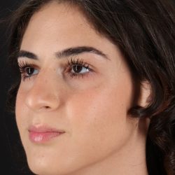 Rhinoplasty Before & After Patient #5572
