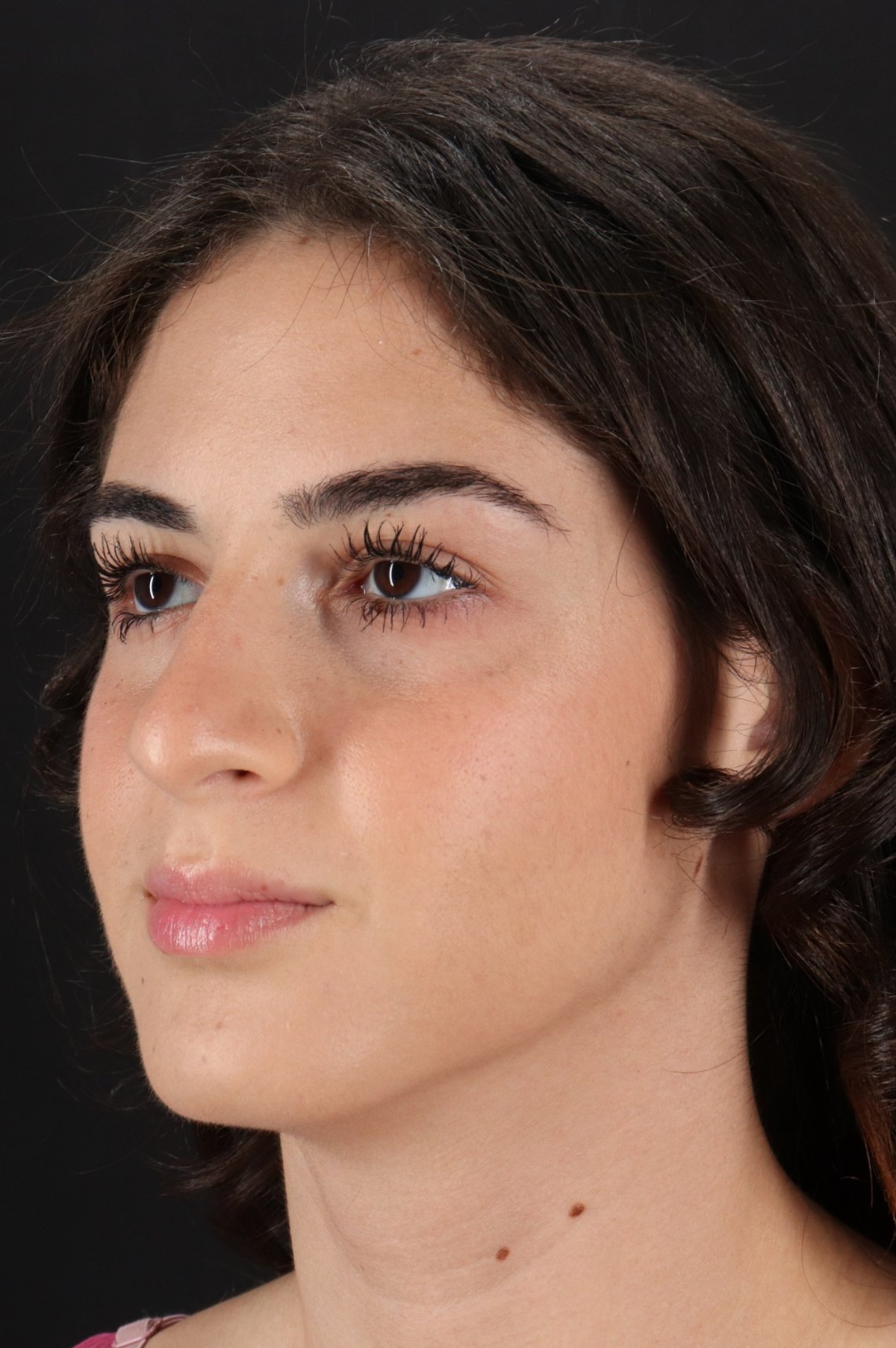 Rhinoplasty Before & After Patient #5572