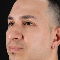 Rhinoplasty Before & After Patient #5518